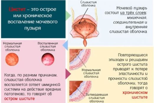 Выделения при цистите фото