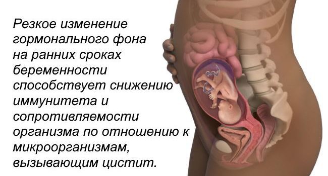Цистит на ранних сроках беременности: причины, лечение и последствия