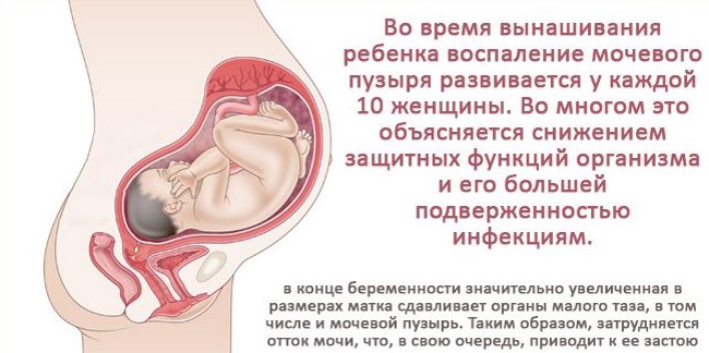 Цистит у беременных