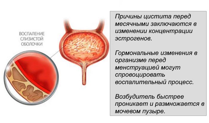 Почему кровь при цистите. Воспалительный процесс в мочевом пузыре.