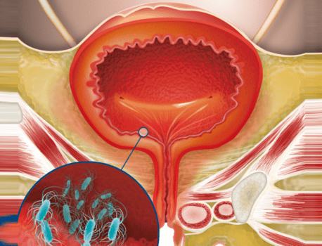Шеечный цистит