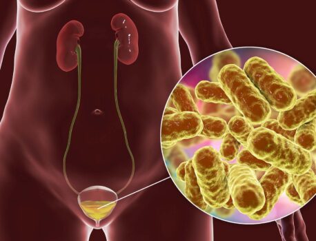 Хронический цистит у женщин