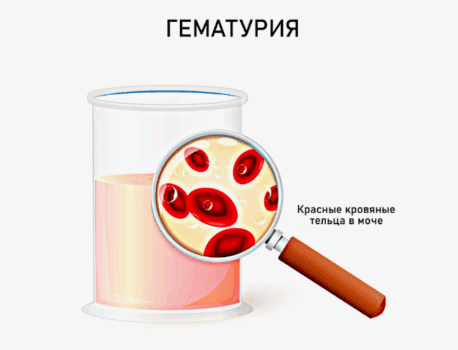 При цистите может быть кровь?